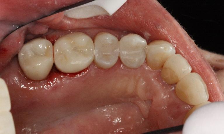 All-Porcelain-Crowns-After-Image