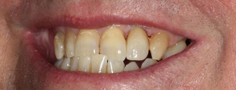 Implant-Crowns-After-Image