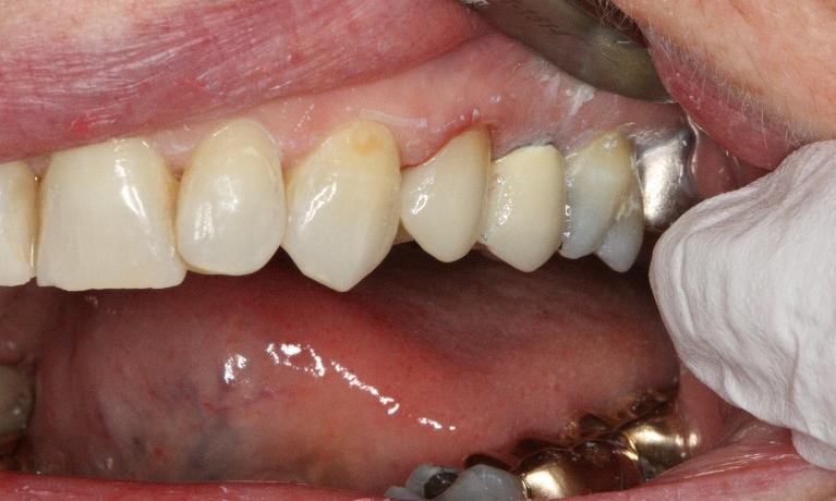 All-Porcelain-Crowns-After-Image