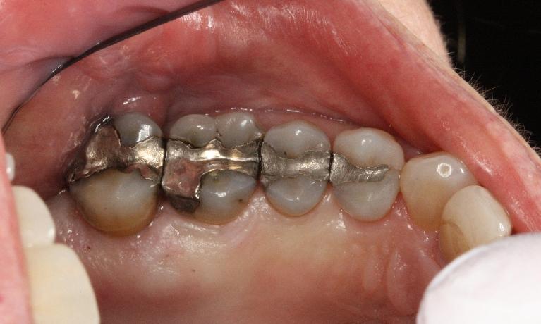 All-Porcelain-Crowns-Before-Image