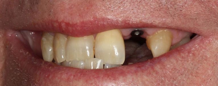 Implant-Crowns-Before-Image