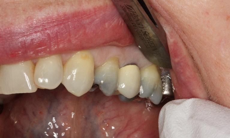 All-Porcelain-Crowns-Before-Image